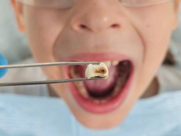 Best Emergency Dental Care for Broken or Chipped Teeth in Three Rivers, MI